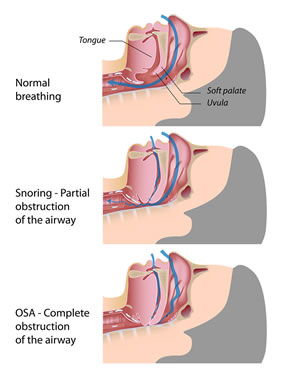 snoring and apnea